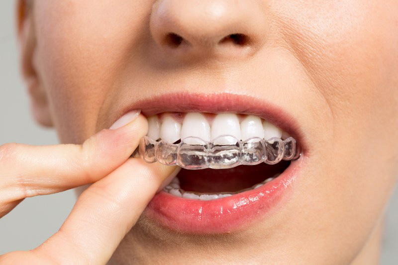 Invisalign : Avis sur l'Appareil Dentaire Invisible + Traitement